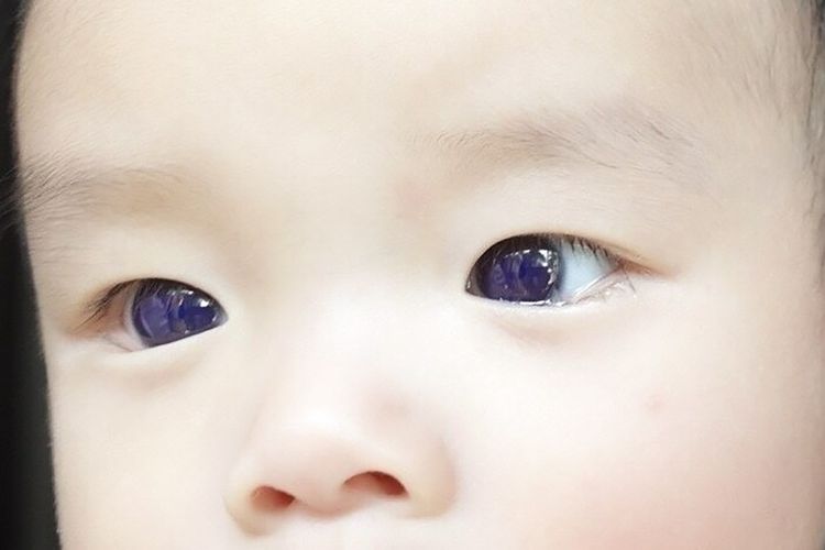 Bayi yang warna matanya berubah menjadi biru di Thailand usai terapi Covid-19