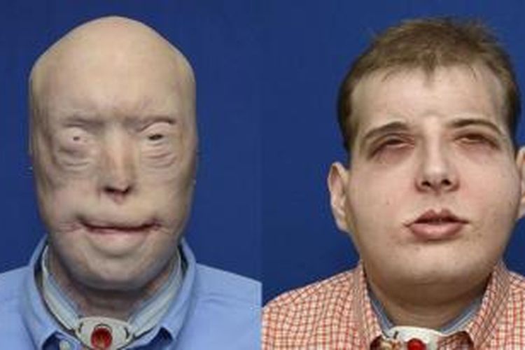 Wajah Hardison setelah operasi transplantasi wajah.