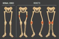 Kenali Apa itu Rakitis, Penyebab, dan Cara Mencegahnya