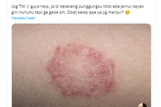 Ramai soal Jamur Ringworm, Apa Obatnya?