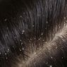 10 Obat Alami untuk Mengatasi Ketombe Rambut yang Bisa Dicoba di Rumah