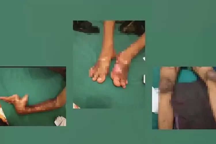Tubuh Terbakar Saat Lembur, Pekerja Jambi Mengaku Diminta Tulis Kecelakaan Terjadi di Rumah