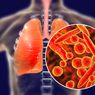 4 Gejala Pneumonia karena Mycoplasma Pneumoniae dan Cara Mengobatinya 