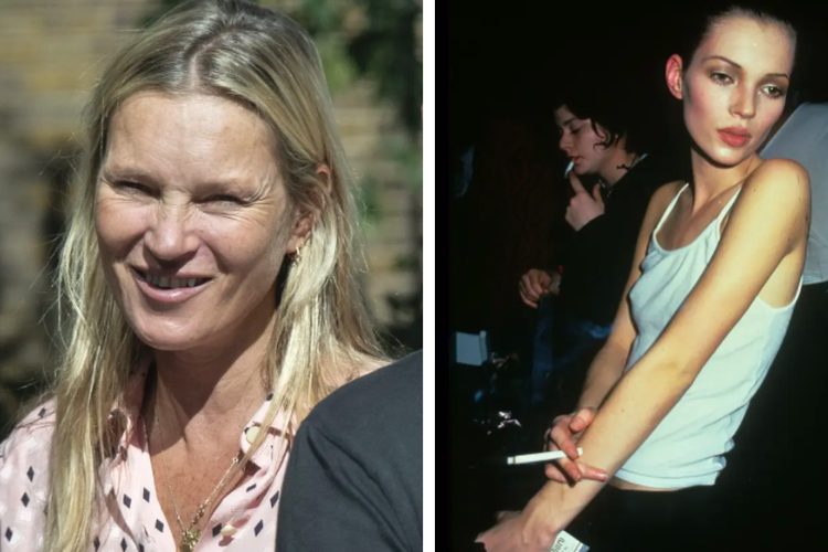 Kondisi kulit Kate Moss yang kering dan kendur akibat merokok