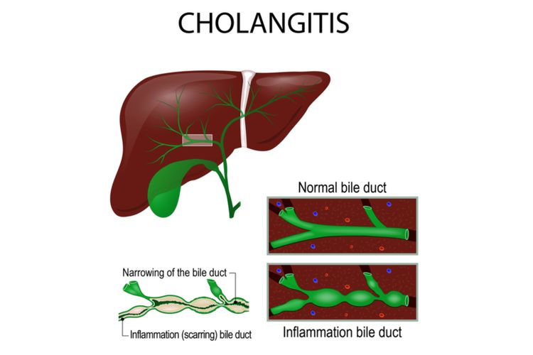 Ilustrasi Cholangitis atau kolangitis