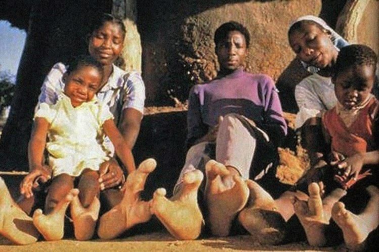Suku Vadoma di Zimbabwe memiliki anggota tubuh menyatu