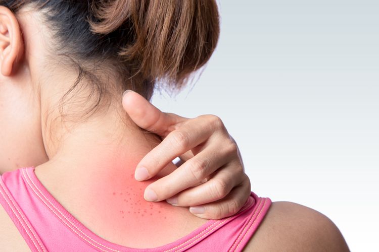 Mengetahui cara mencegah biang keringat sangat penting agar kulit tidak terasa gatal.