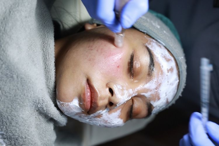 Ini Area Wajah dan Tubuh yang Sering Muncul Jerawat Saat Stres