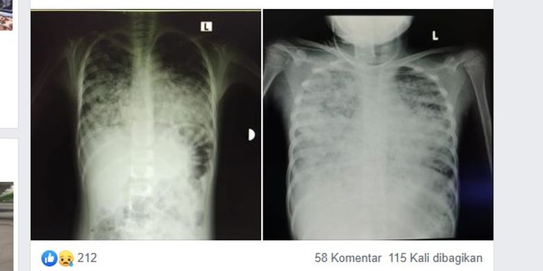 Tangkapan layar kondisi paru-paru milik seorang pasien anak berusia 7 tahun yang diduga positif terinfeksi virus corona. Perbandingan kedua foto paru kurang dari 24 jam infeksi semakin meluas telah terjadi pneumonia bilateral.