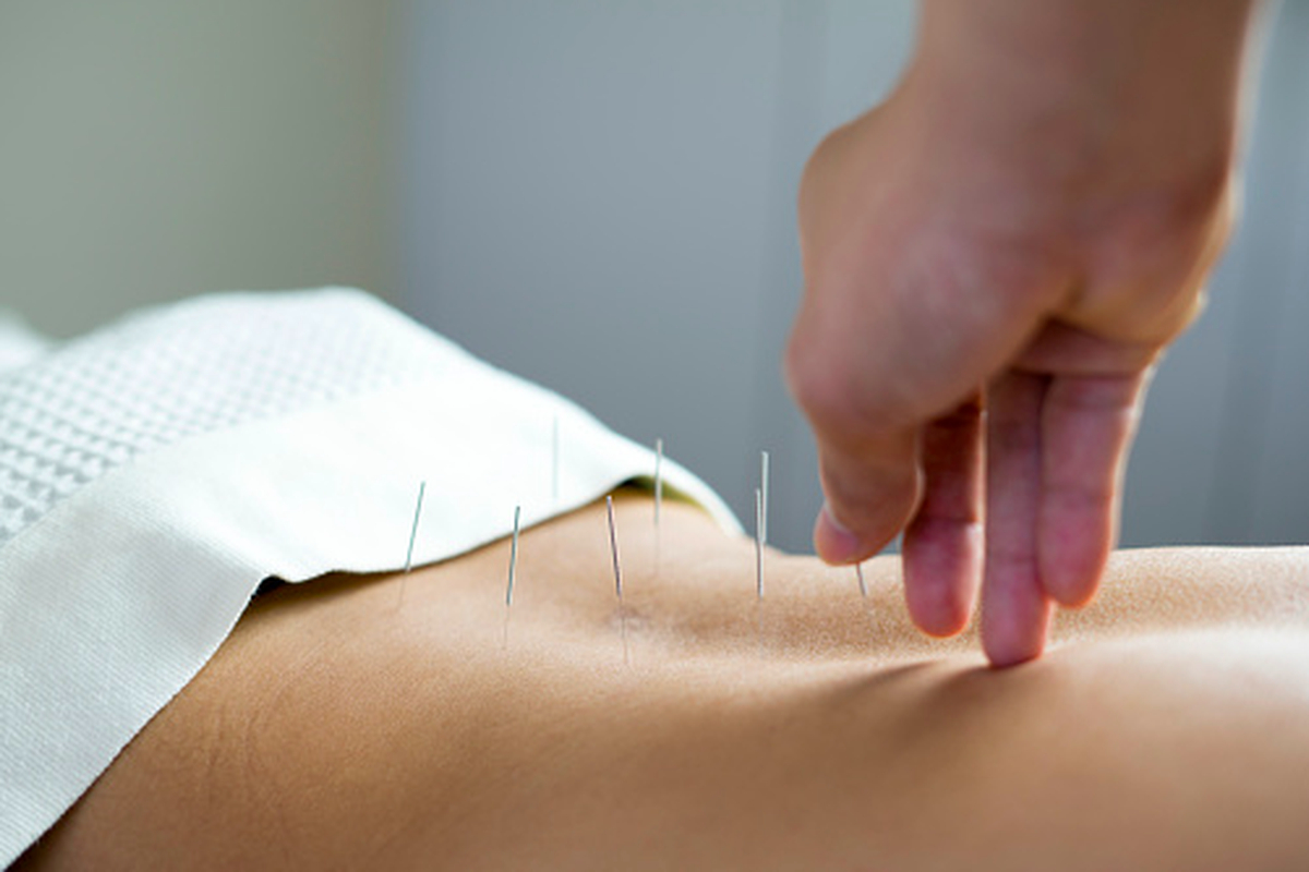 Ilustrasi akupunktur untuk tingkatkan peluang kehamilan