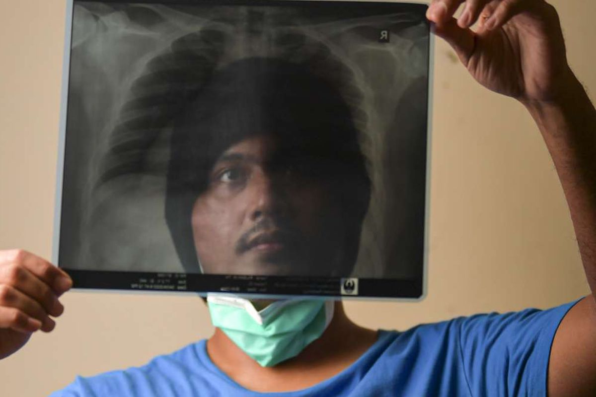 Rilsan Malkhi (26) menunjukkan hasil rontgen paru-paru miliknya di Jakarta. Karyawan swasta itu menjalani isolasi di RSPAD Gatot Soebroto dan dinyatakan negatif 14 April 2020.