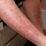 Dermatitis Herpetiformis