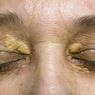 Xanthelasma