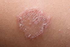 Mengenal Jamur Ringworm dan Cara Penularannya