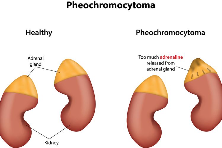 Ilustrasi Pheochromocytoma