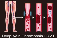 Trombosis Vena Dalam (DVT)