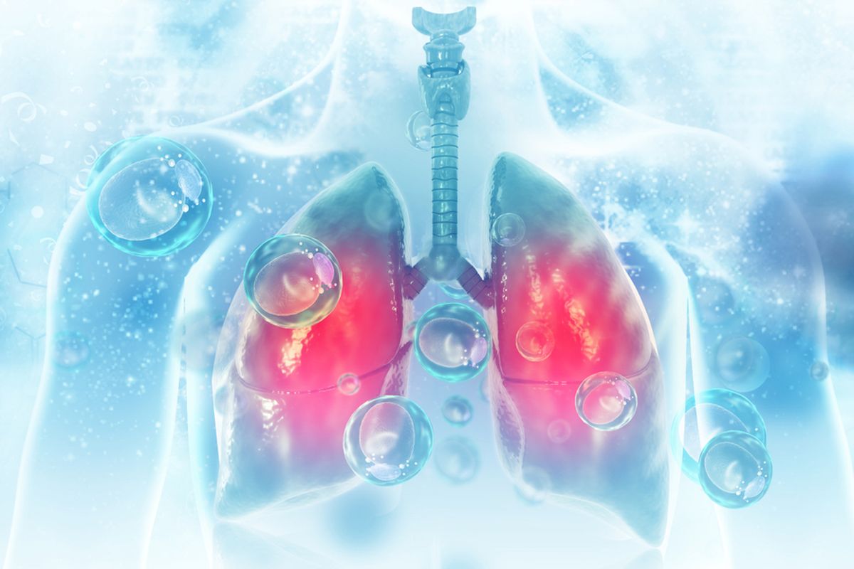 Ilustrasi CT scan dada tunjukkan pneumonia, virus corona penyebab Covid-19.