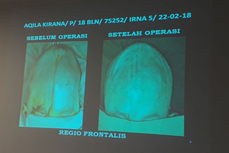 Tempurung kepala Kirana sebelum dan sesudah dioperasi.