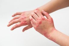 Mengatasi Psoriasis dengan 14 Bahan Alami