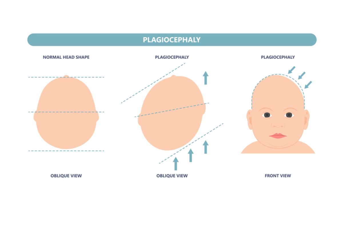 Ilustrasi plagiocephaly