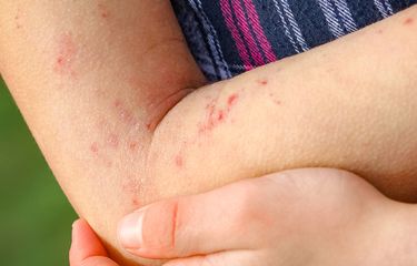 Alergi juga bisa menyebabkan kulit kering atau dikenal sebagai kontak dermatitis.