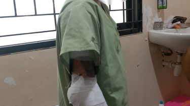 Bocah Perempuan di Semarang Diduga Dibakar Paman, Awalnya gara-gara Tak Mau Mandi