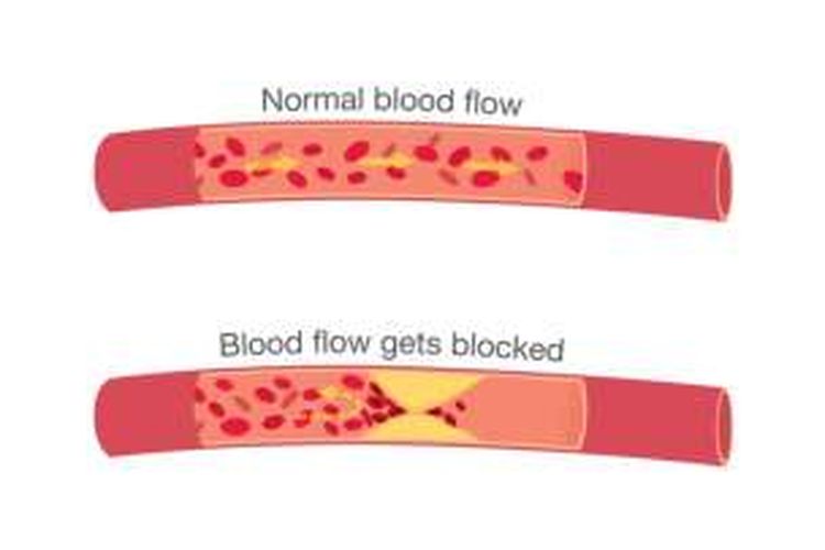 Ilustrasi penyumbatan pembuluh darah. 