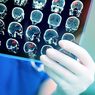 Apa Penyebab Terjadinya Tumor Otak?