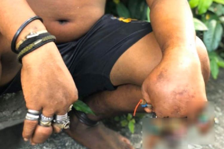 Seorang pria di Thailand terlihat mengenakan banyak cincin dan karet gelang yang membuat jari tangannya membengkak dan membusuk.
