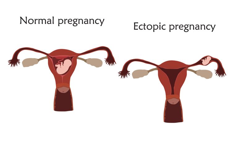 Ilustrasi kehamilan ektopik