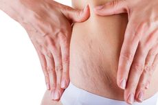 Selulit atau Stretch Mark, Mana yang Lebih Sulit Dihilangkan?