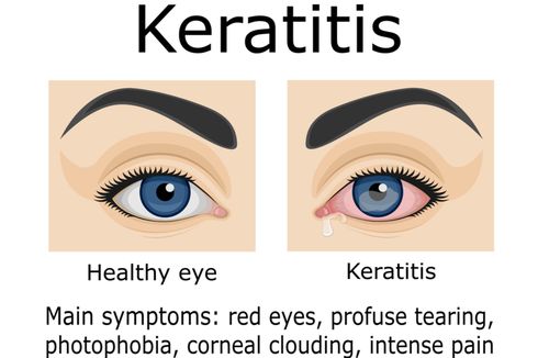 Keratitis