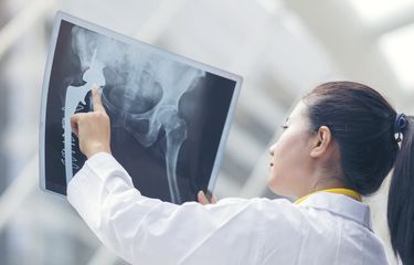 Seorang dokter sedang memeriksa hasil X-Ray pasien kanker tulang. Cara mengobati kanker tulang yang paling umum meliputi operasi, kemoterapi, dan radioterapi. 