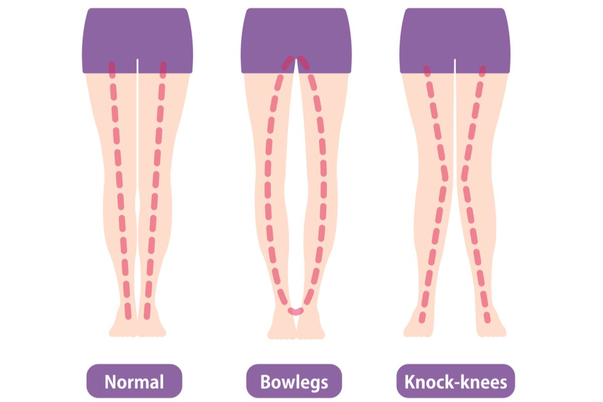 ilustrasi kaki berbentuk x dan o