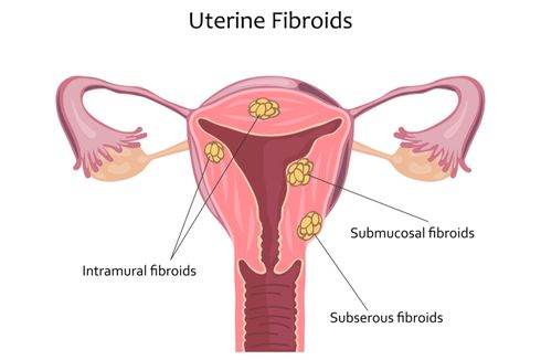 3 Jenis Makanan yang Dapat Mencegah Fibroid Rahim Menurut Dokter