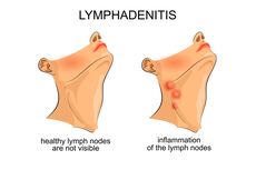 Limfadenitis