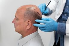 Rambut Tumbuh Setelah Hair Transplant, Proses dan Perkembangannya 