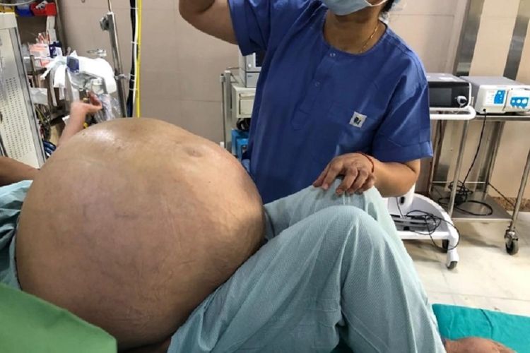 Dokter ketika melakukan pemeriksaan terhadap perut seorang wanita di Delhi, India, yang mengalami tumor ovarium. Dokter disebut berhasil mengeluarkan tumor dengan bobot setara remaja 15 tahun tersebut.