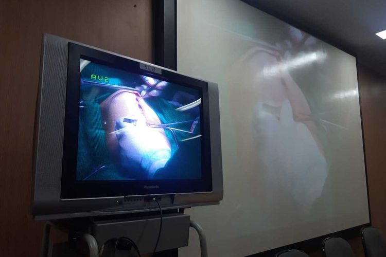 Layar monitor yang menunjukkan proses operasi pemisahan bayi kembar siam Aqila dan Azila di RSU dr Soetomo, Rabu (14/8/2019)