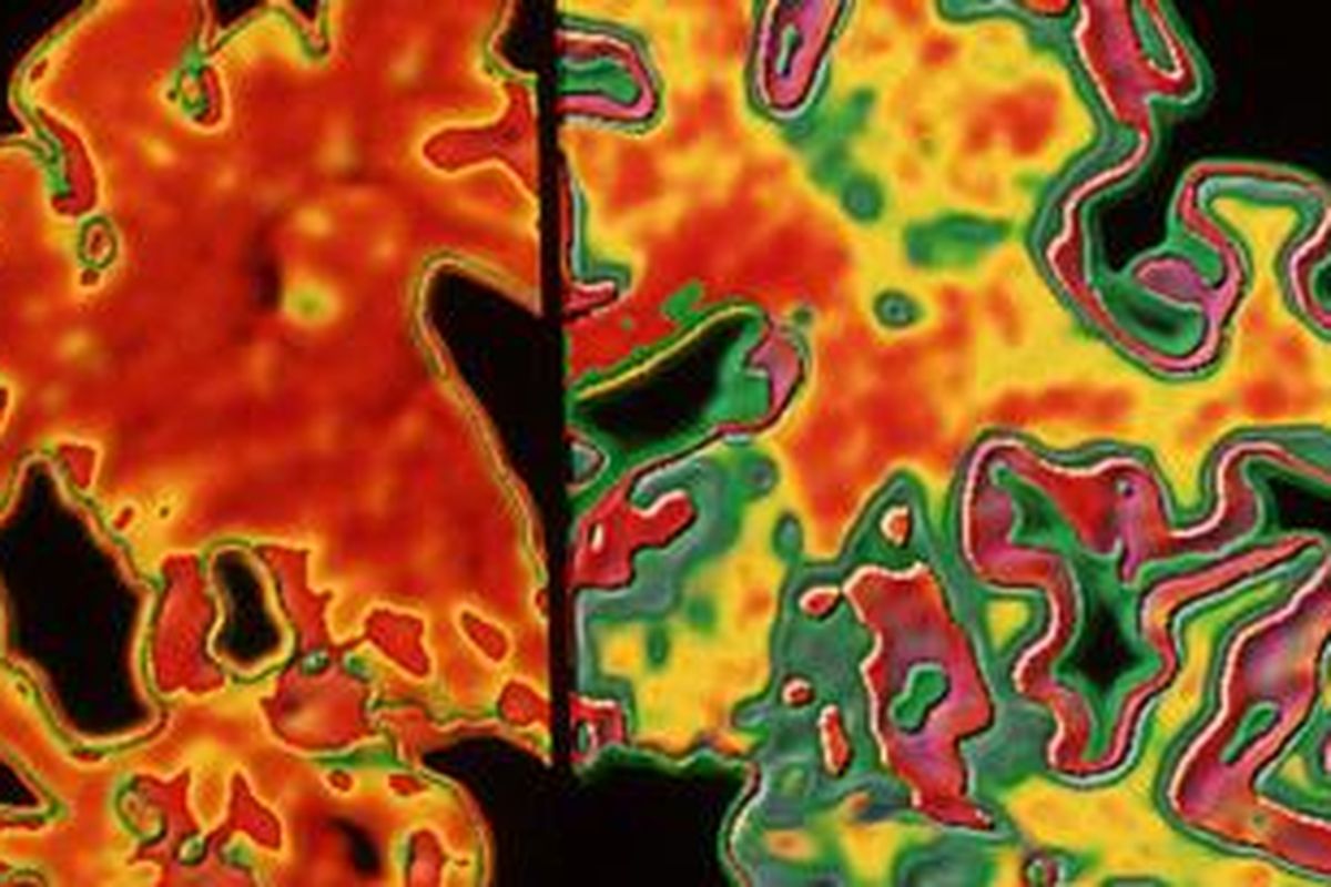 Perbedaan otak sudah bisa dilihat lebih dari 20 tahun sebelum gejala pertama.