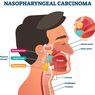 Karsinoma Nasofaring