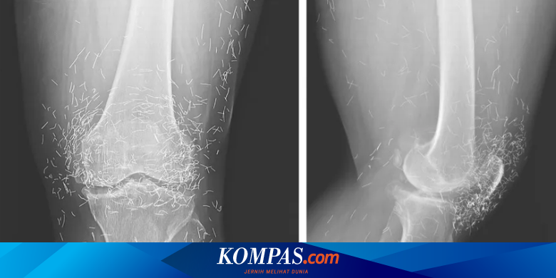 Alami Nyeri Sendi Parah, Ternyata Ada Ratusan Benang Emas di Lutut Nenek asal Korea Selatan Ini