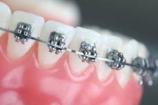 Perlukah Gigi Geraham Bungsu Dicabut Sebelum Pakai Kawat Gigi?