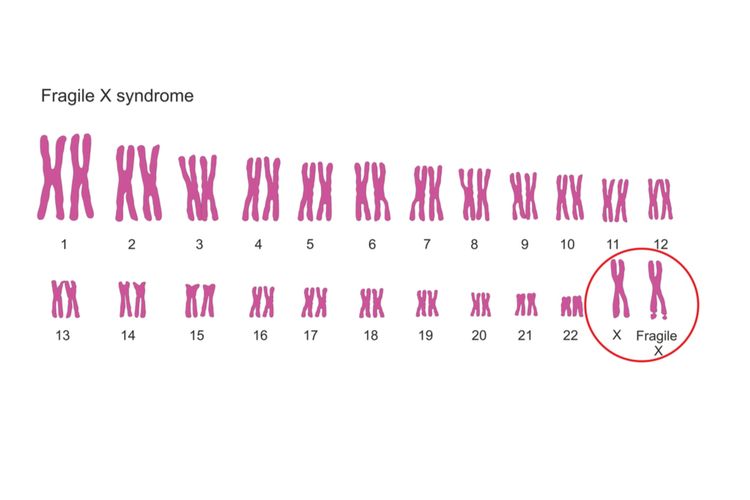 Ilustrasi sindrom fragile x