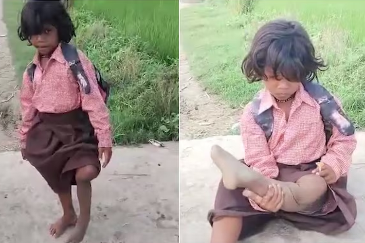 Semangat Ragini Bersekolah, Tiap Hari Berjalan dengan 1 Kaki Sejauh 400 Meter