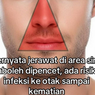 Ramai Narasi Pencet Jerawat di Hidung Bisa Sebabkan Infeksi Otak, Benarkah?