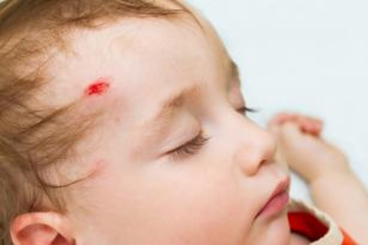 Jika anak mengalami cedera kepala, sebaiknya dipantau kondisinya selama 72 jam pertama.