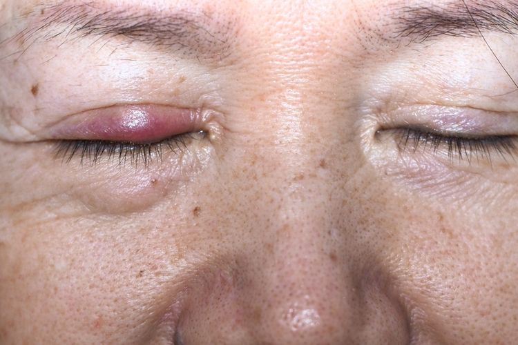 Bintitan di kelopak mata dalam sering ditandai dengan benjolan seperti jerawat atau bisul yang dapat mengganggu penglihatan.