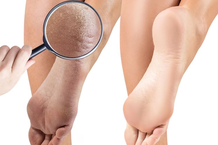 8 Cara Menghilangkan Tumit Kaki Pecah-pecah Secara Alami