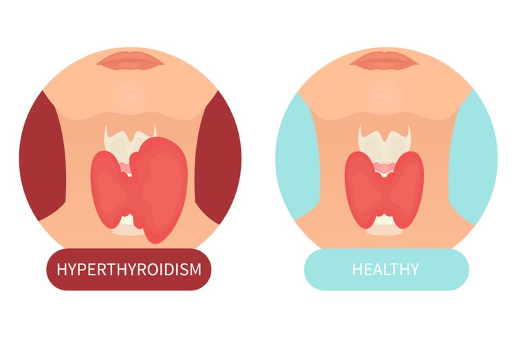 Ilustrasi hipertiroidisme